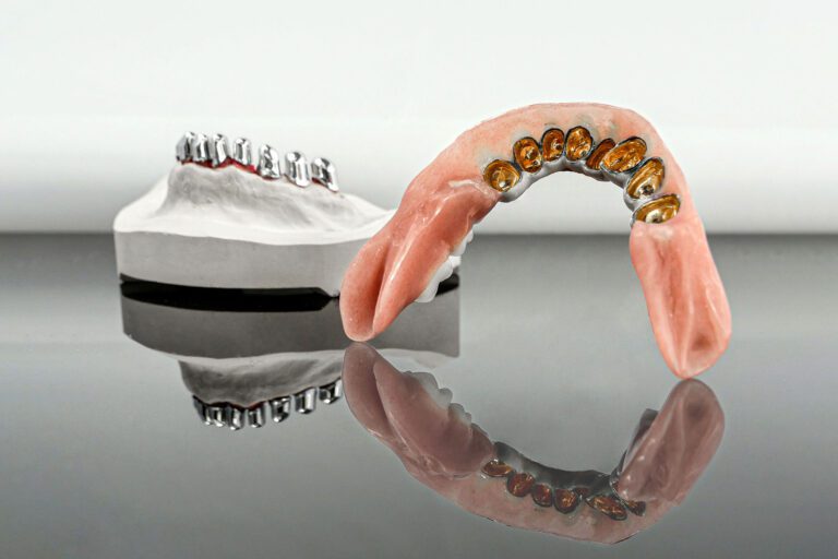 Herausnehmbarer Zahnersatz - Kombination aus Primärteleskopen mit Galvano Sekundärkäppchen und Kunstoff-Prothetik