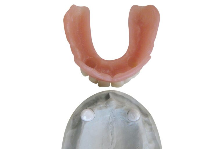 Metallfreier Zahnersatz Primär und Sekundär