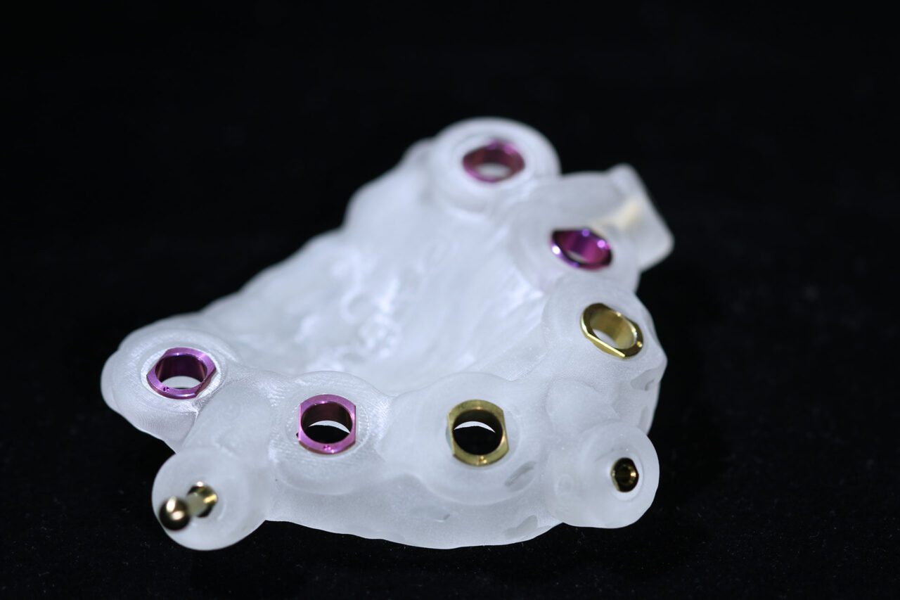 3D-gedruckte chirurgische Schablone mit Bohrhülsen und Fixierungspins