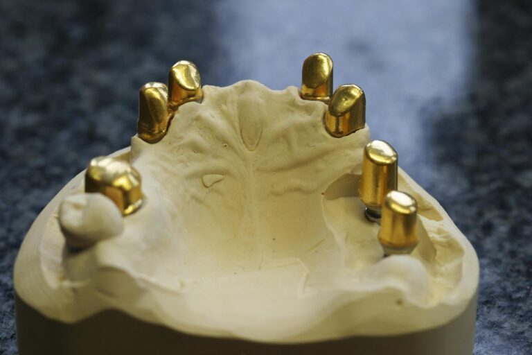 Zirkon primär Kronen auf Implantaten und Zähnen sekundär Galvano