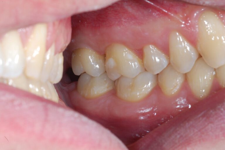 Keramikkrone letzter Zahn