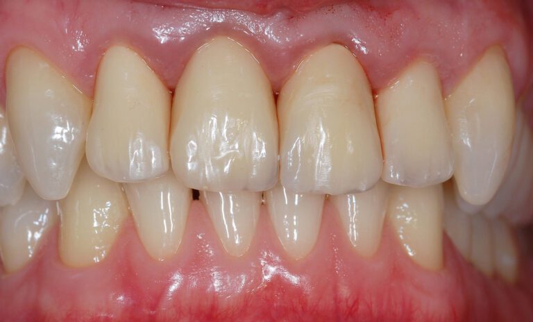 Kontrolle nach 3 Tagen – das Zahnfleisch hat sich erholt durch Zirkongerüst