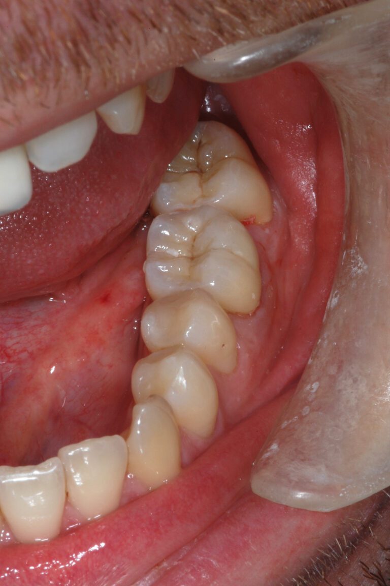 Zirkonkronen nachher – Zähne wie gewachsen