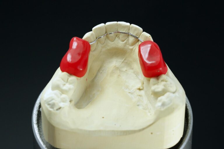 Gebogener Retainer mit Einbrunghilfe zur Schienung der Zähne nach erfolgreicher Aligner-Therapie