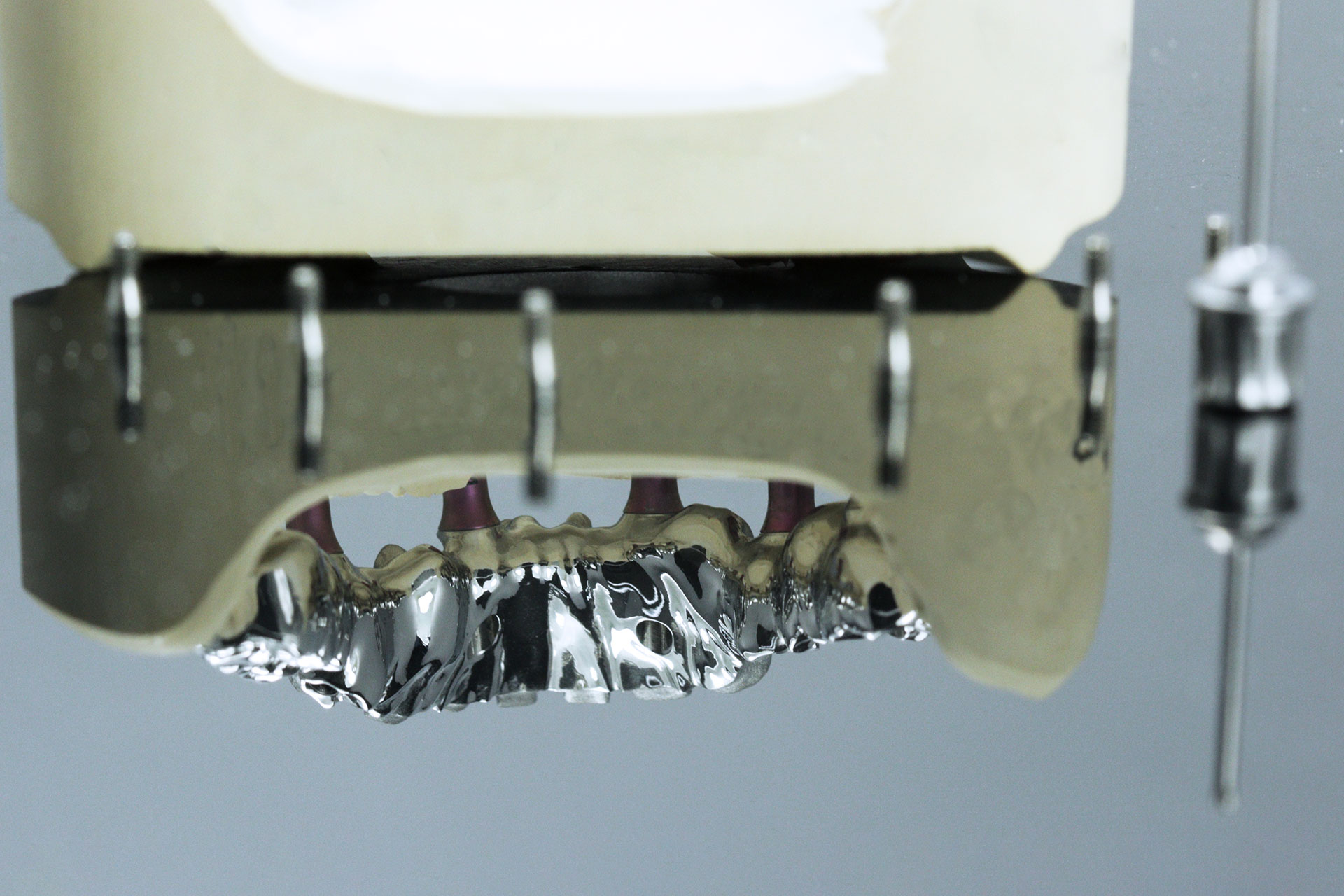 Okklusal verschraubte, vestibulär verblendete Metallbrücke auf Implantaten
